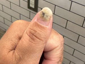 「グリーンネイル」ってなに？知らないと怖い爪の病気